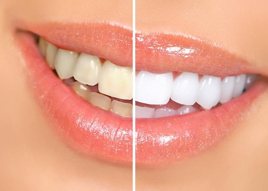 What Can I Do About My Stained Teeth?