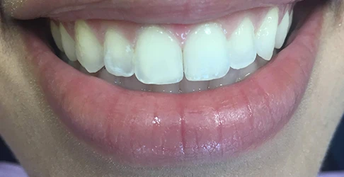 After smile transformation