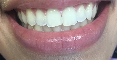 Before smile transformation
