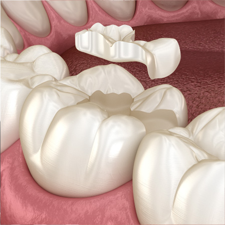 Dental Inlays and Onlays